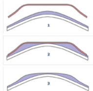 Ортокератологія - спосіб корекції короткозорості і короткозорого астигматизму при допомогою особливих контактних лінз нічного носіння